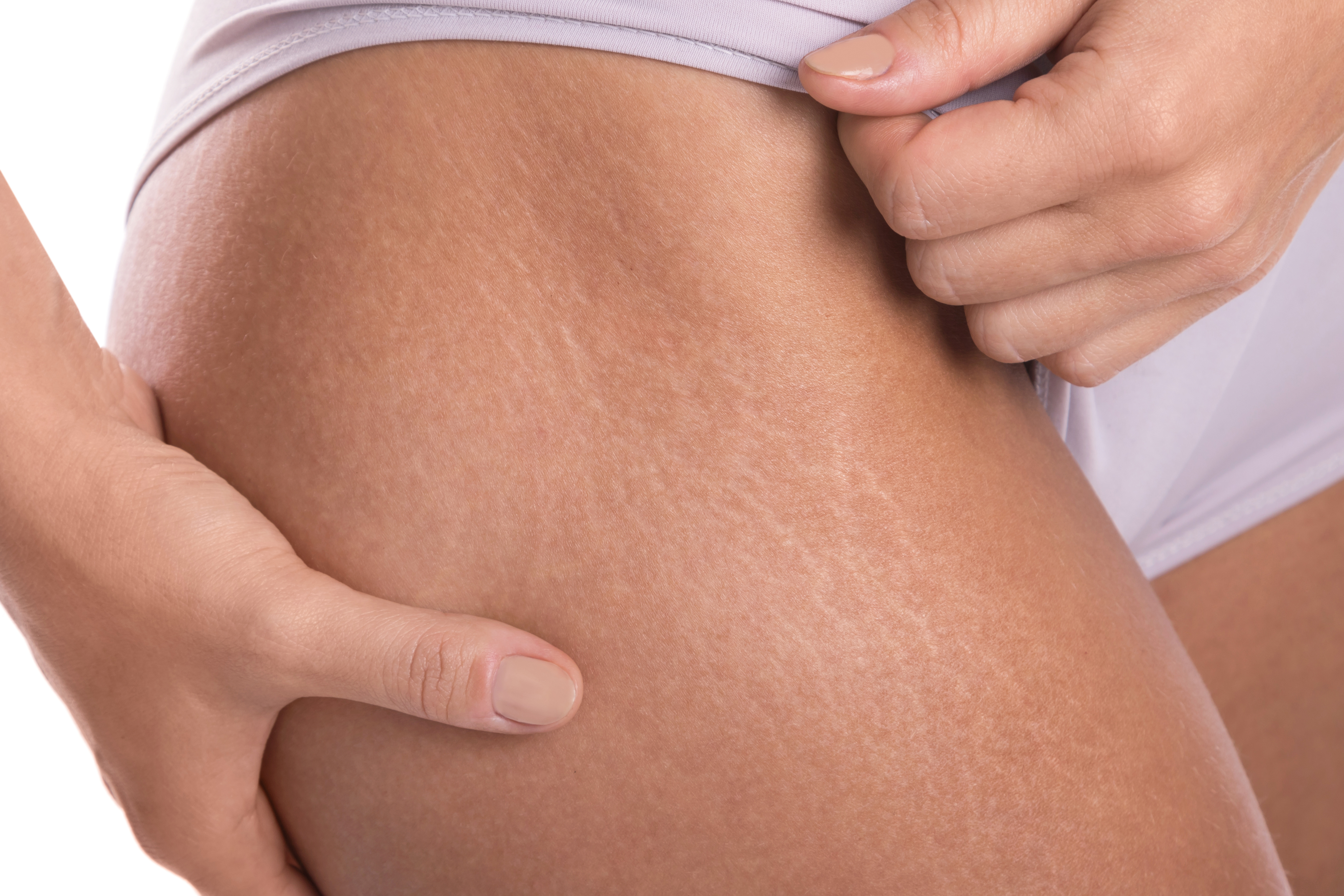 vigtigste Foran dig købe The Causes of Stretch Marks Without Weight Gain | livestrong